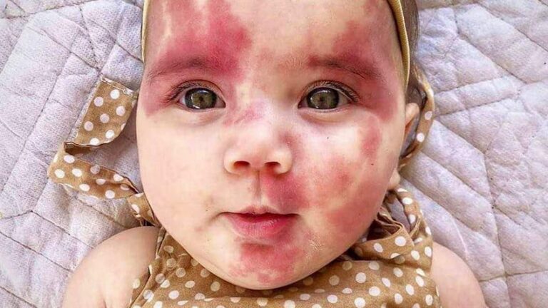 Abrazando la belleza: El viaje de una niña con una mancha de vino de Oporto como marca de nacimiento