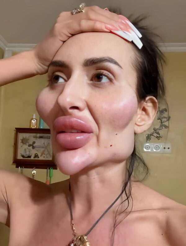 A Woman With The Largest Cheekbones: What Did She Look Like Before The Transformation?