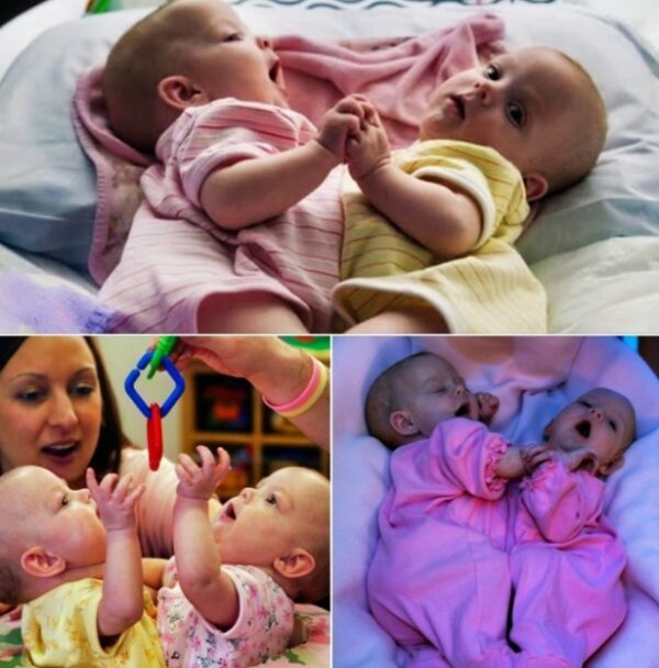 The Siamese Twins Separated In 2006: You Won’t Believe How They Look Today!