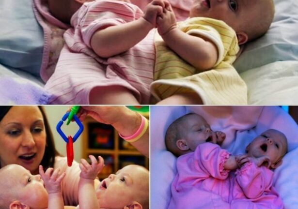 The Siamese Twins Separated In 2006: You Won’t Believe How They Look Today!