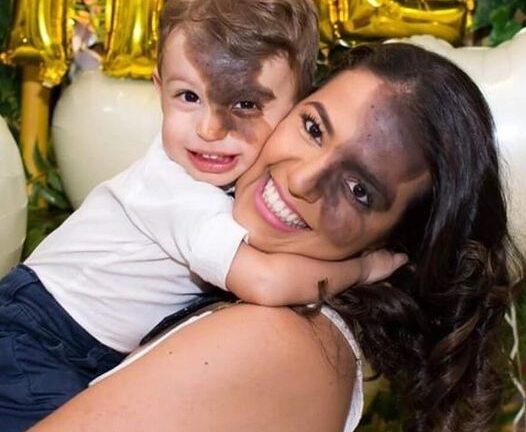 “I Didn’t Want My Son To Feel Different”: A Mom Got a Replica Of Her Son’s Dark Birthmark So That The Boy Didn’t Feel Ashamed Of His Face!