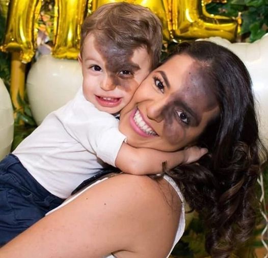 “I Didn’t Want My Son To Feel Different”: A Mom Got a Replica Of Her Son’s Dark Birthmark So That The Boy Didn’t Feel Ashamed Of His Face!