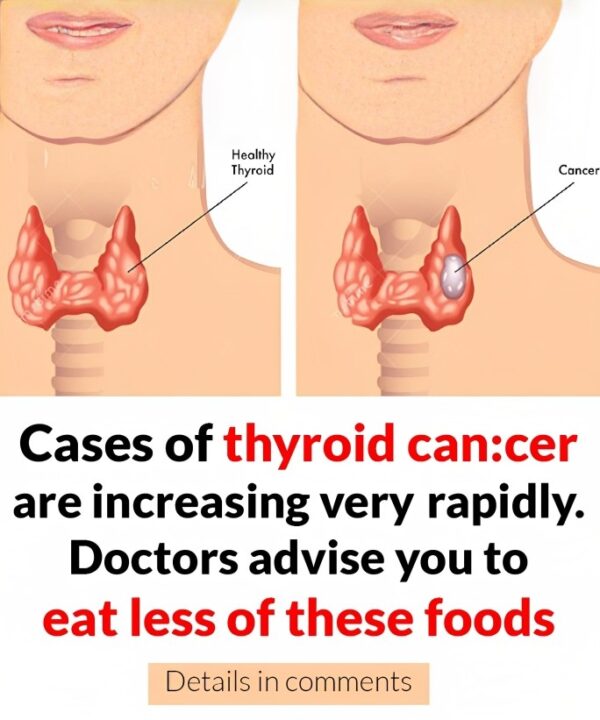 Cases of thyroid can:cer are increasing rapidly. Doctors advise you to eat less of these foods