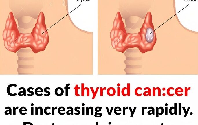 Cases of thyroid can:cer are increasing rapidly. Doctors advise you to eat less of these foods