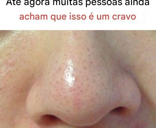 O que são filamentos sebáceos e por que eles aparecem na sua pele?
