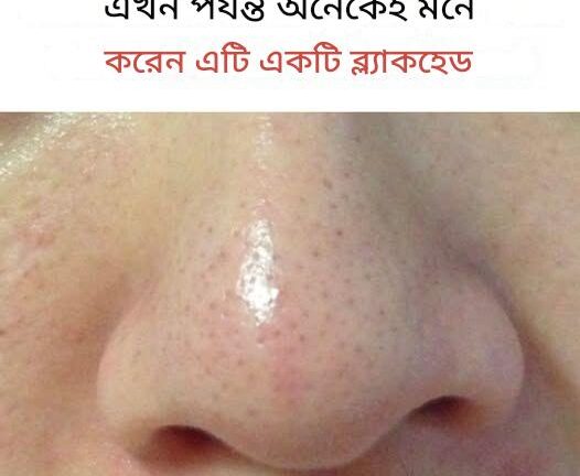 সিবেসিয়াস ফিলামেন্ট কী এবং কেন এগুলো আপনার ত্বকে দেখা যায়?