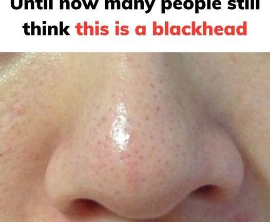 What Are Sebaceous Filaments and Why Do They Appear on Your Skin?