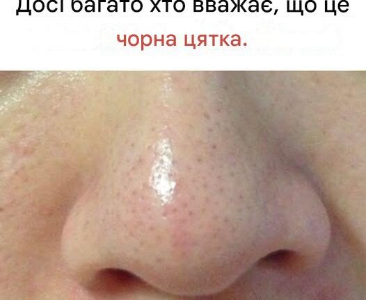 Що таке сальні нитки та чому вони з’являються на вашій шкірі?
