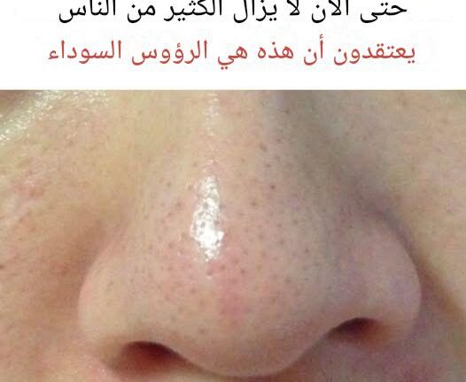 ما هي الخيوط الدهنية ولماذا تظهر على بشرتكِ؟