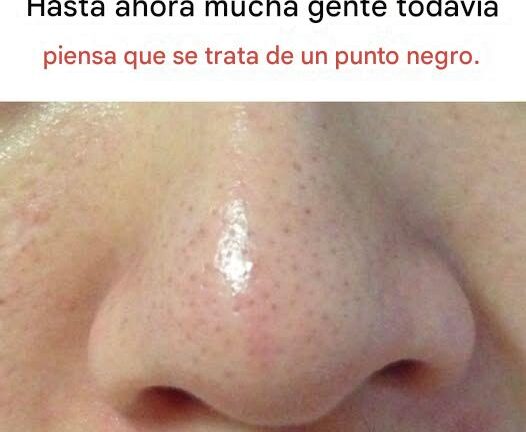 ¿Qué son los filamentos sebáceos y por qué aparecen en la piel?