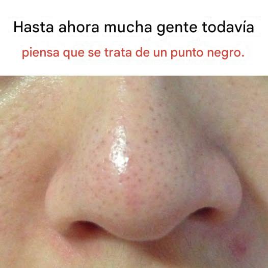 ¿Qué son los filamentos sebáceos y por qué aparecen en la piel?