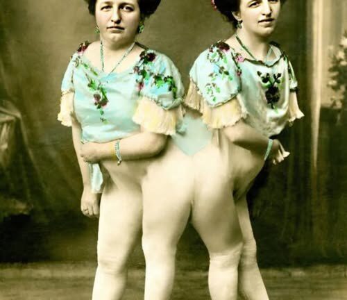 One of the Siamese Twins Got Pregnant and Gave Birth to a Son: This Is What Their Baby Looks Like