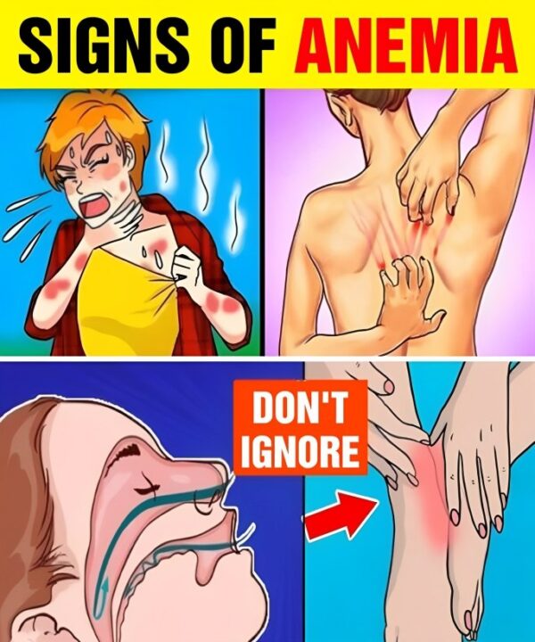 12 Silent Symptoms of ANEMIA You Shouldn’t Ignore