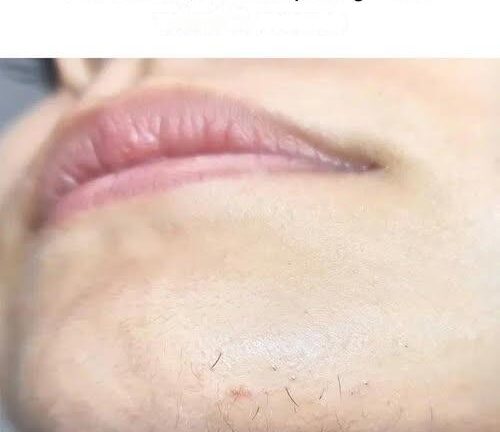 ¿Ese molesto vello en la barbilla? Esto es lo que tu cuerpo podría estar diciéndote