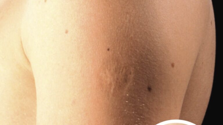 Here’s The Truth Behind This Scar On People’s Upper Left Arm