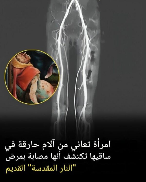 امرأة تعاني من آلام حارقة، يتبين أنها مصابة بمرض “النار المقدسة” الذي يعود للعصور الوسطى