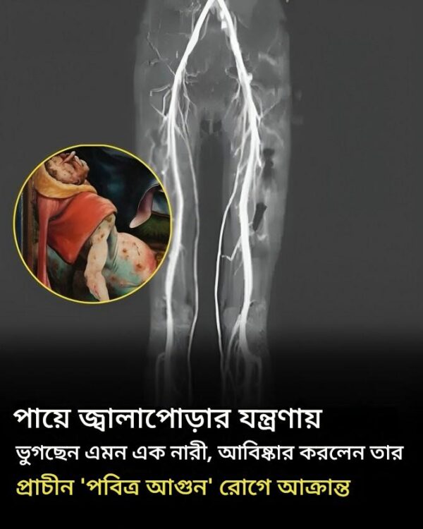 জ্বলন্ত যন্ত্রণায় ভুগছেন এমন মহিলার মধ্যযুগীয় ‘পবিত্র অগ্নি’ রোগে আক্রান্ত হওয়ার খবর পাওয়া গেছে