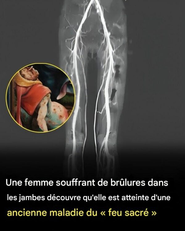 Woman Experiencing Burning Pains Turns Out To Have Medieval ‘Holy Fire’ Disease