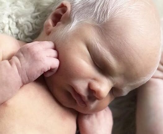 From Mockery to Joy: The Inspiring Journey of an Albino Child