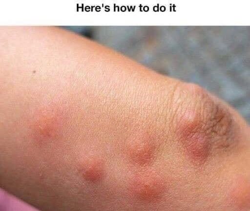 Quick tricks to stop mosquito bites from itching