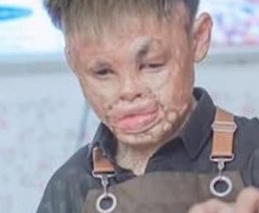 As a toddler, he was horrifically burned when he fell into a wood stove