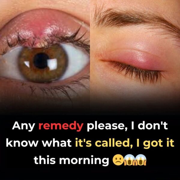 Say Goodbye to Eye Styes: Discover Natural Remedies