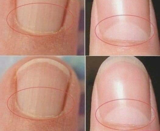 If your nails don’t have a half-moon shape, it’s important to see a doctor right away.