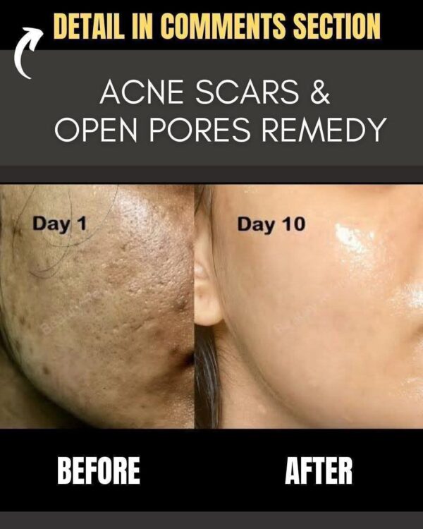 Acne Scars and Open Pores Remedy