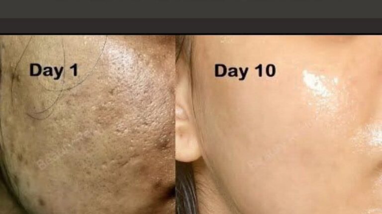 Acne Scars and Open Pores Remedy