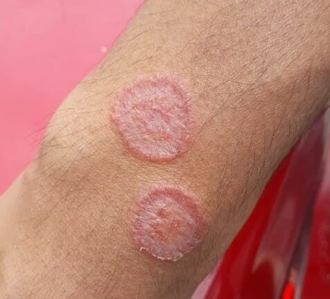 HT10. Ringworm (Tinea Corporis): Causes, Symptoms, Treatment, and Prevention