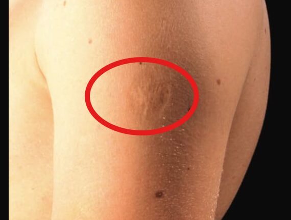 Here’s The Truth Behind This Scar On People’s Upper Left Arm