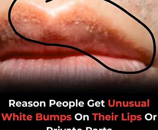 Why You Might See Unusual White Bumps On Your Lips Or Genitals