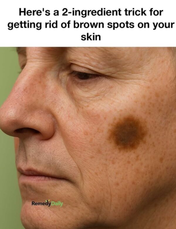 Here’s a 2-ingredient hack for getting rid of brown spots on your skin