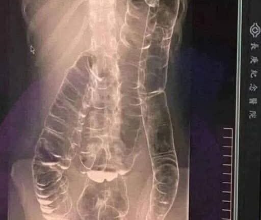 Severe Constipati!!!