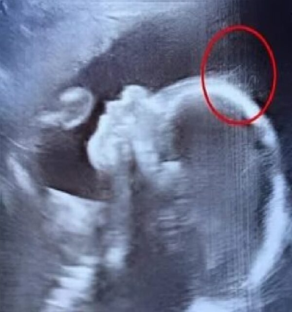 Doctors Were Speechless After Spotting This on the Baby’s Ultrasound