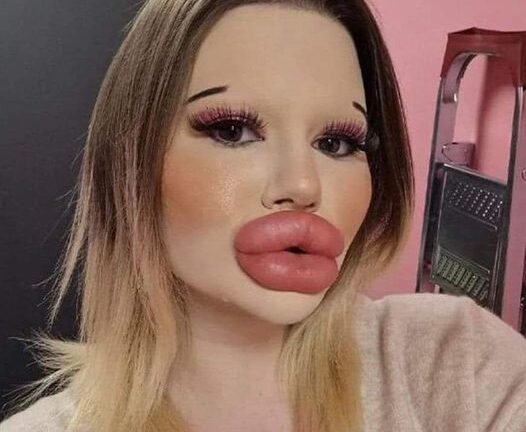 24-year-old woman wants the biggest lips in the world