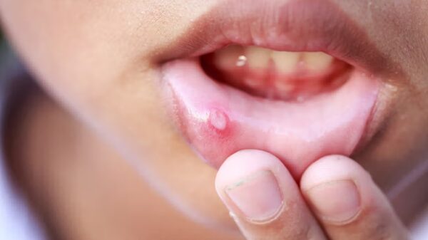 Crohn’s Disease Mouth Sores: Causes, Symptoms, and Treatments