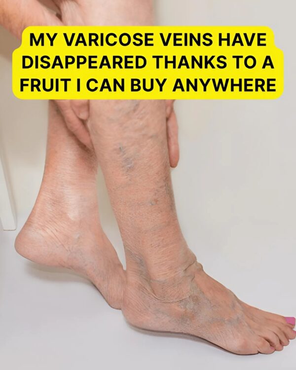 My Varicose Veins Have Disappeared Thanks To A Fruit I Can Buy Anywhere