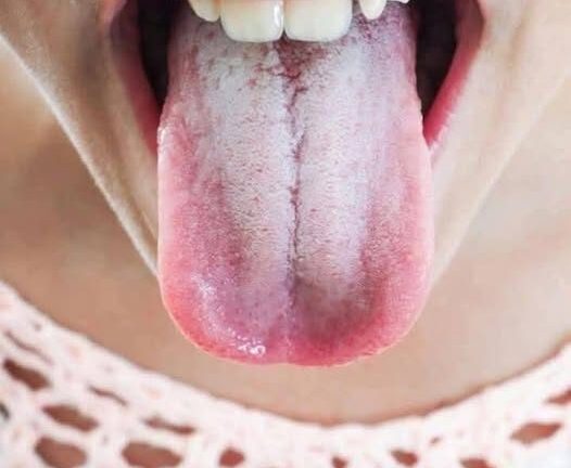 If your tongue is white, this is a clear sign that you are suffering from