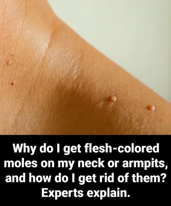 Why Do I Get Flesh-Colored Moles on My Neck or Armpits