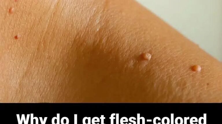Why Do I Get Flesh-Colored Moles on My Neck or Armpits