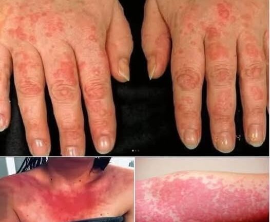 HT10. Red, Itchy, and Sweaty Skin are the consequences of having s… See more