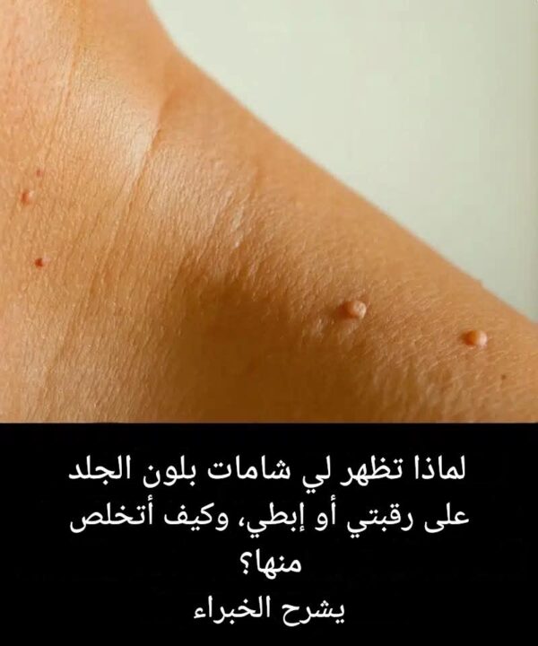 لماذا تظهر لديّ شامات بلون الجلد على رقبتي أو تحت إبطيّ؟