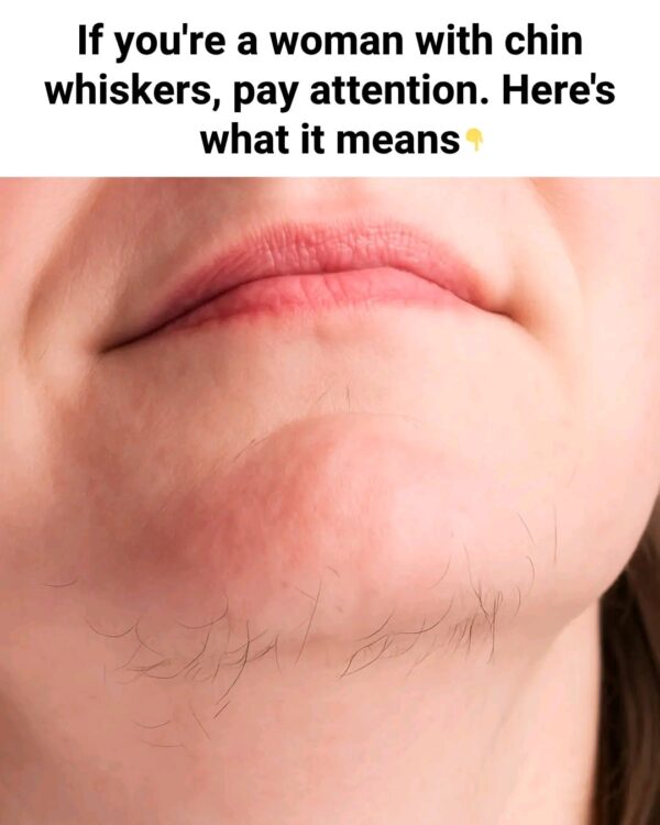 Understanding and Managing Chin Whiskers in Women: Causes, Impact & Solutions