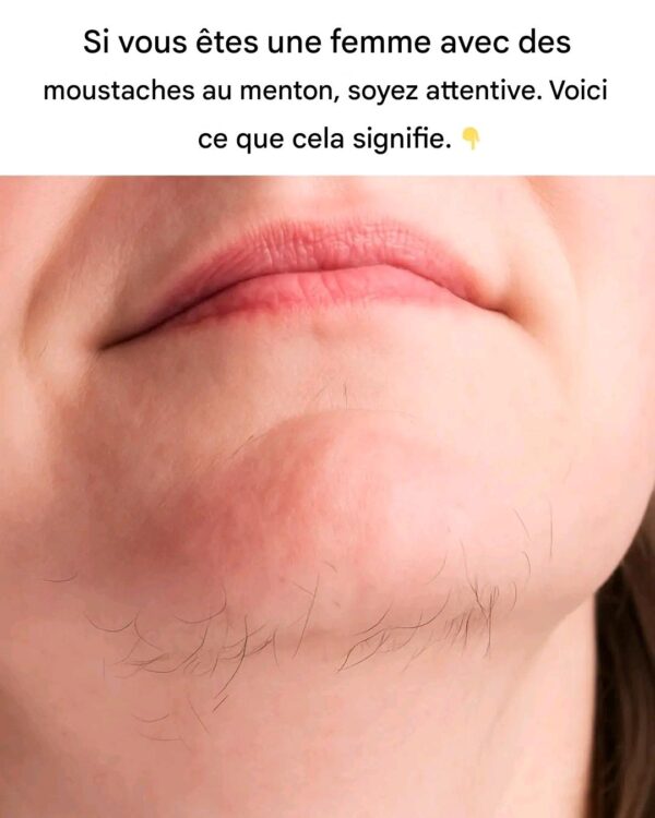 Comprendre et gérer les poils du menton chez la femme : causes, conséquences et solutions