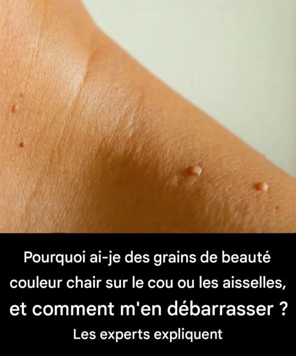 Pourquoi ai-je des grains de beauté couleur chair sur le cou ou les aisselles ?