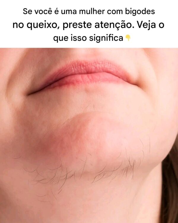 Compreendendo e Tratando a Queixo-bigode em Mulheres: Causas, Impacto e Soluções