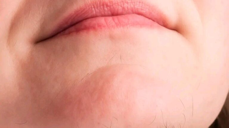 Compreendendo e Tratando a Queixo-bigode em Mulheres: Causas, Impacto e Soluções