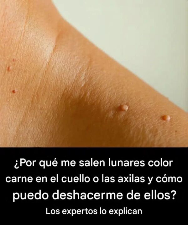 ¿Por qué me salen lunares color carne en el cuello o las axilas?