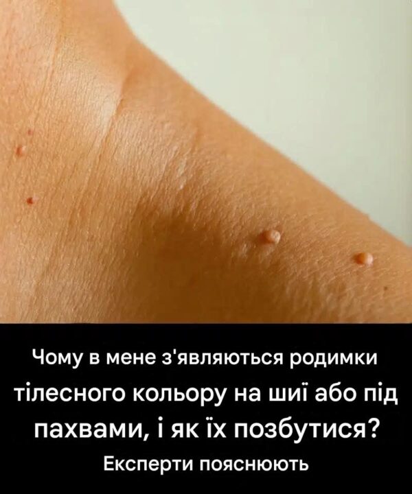 Чому у мене на шиї або під пахвами з’являються родимки тілесного кольору